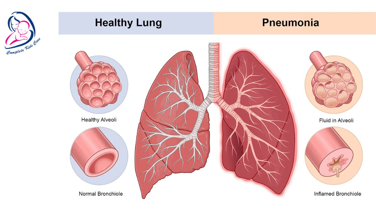 Pneumonia - Dr Priyanka Jain - Vaccination Specialist (3)